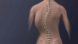 علاج اعوجاج العمود الفقري عند الكبار